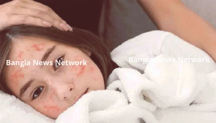 হাম হলে কী করবেন